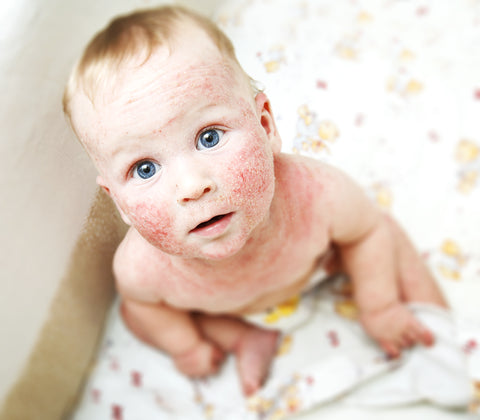 Addressing Eczema In Babies