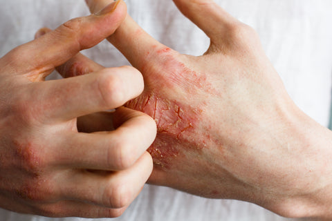 Eczema Rash? Here Is Why