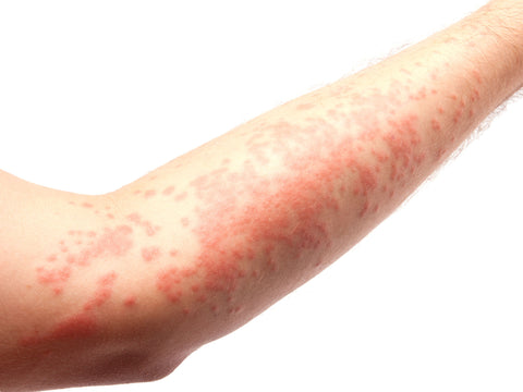 Eczema, What Is It?