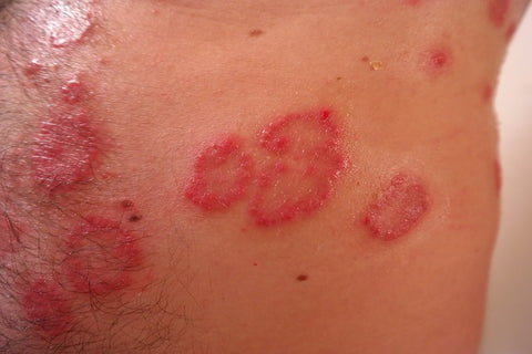 What Is Psoriasis and What To Do About It