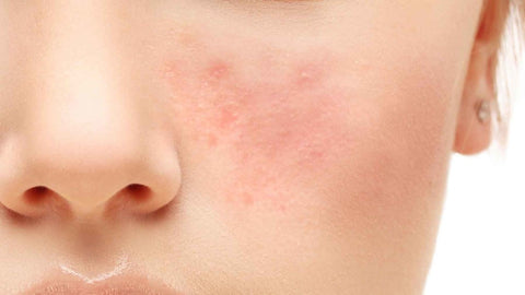 What Is Rosacea and How To Treat It
